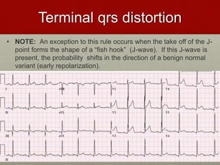 Terminal qrs distortion
• NOTE: An exception to this rule occurs when the take off of the J-
point forms the shape of a “fish hook” (J-wave). If this J-wave is
present, the probability shifts in the direction of a benign normal
variant (early repolarization).
 