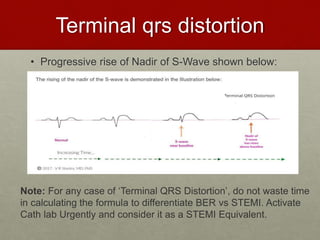 Terminal qrs distortion
• Progressive rise of Nadir of S-Wave shown below:
Note: For any case of ‘Terminal QRS Distortion’, do not waste time
in calculating the formula to differentiate BER vs STEMI. Activate
Cath lab Urgently and consider it as a STEMI Equivalent.
 