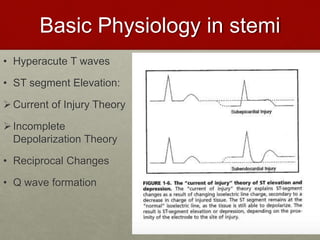 Basic Physiology in stemi
• Hyperacute T waves
• ST segment Elevation:
Current of Injury Theory
Incomplete
Depolarization Theory
• Reciprocal Changes
• Q wave formation
 