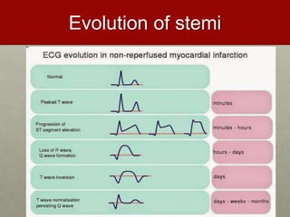 Evolution of stemi
 