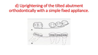 d) Uprightening of the tilted abutment
orthodontically with a simple fixed appliance.
 