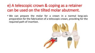 e) A telescopic crown & coping as a retainer
can be used on the tilted molar abutment.
• We can prepare the molar for a crown in a normal long-axis
preparation for the fabrication of a telescopic crown, providing for the
required path of insertion.
 