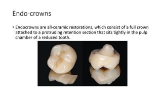 Endo-crowns
• Endocrowns are all-ceramic restorations, which consist of a full crown
attached to a protruding retention section that sits tightly in the pulp
chamber of a reduced tooth.
 