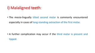 I) Malaligned teeth:
• The mesio-lingually tilted second molar is commonly encountered
especially in cases of long-standing extraction of the first molar.
• A further complication may occur if the third molar is present and
tipped.
 