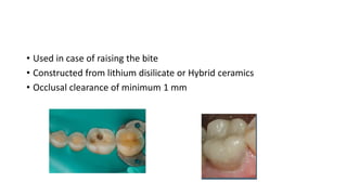 • Used in case of raising the bite
• Constructed from lithium disilicate or Hybrid ceramics
• Occlusal clearance of minimum 1 mm
 