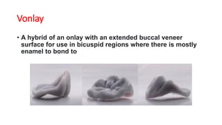 Vonlay
• A hybrid of an onlay with an extended buccal veneer
surface for use in bicuspid regions where there is mostly
enamel to bond to
 
