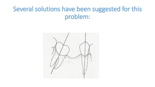 Several solutions have been suggested for this
problem:
 