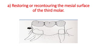 a) Restoring or recontouring the mesial surface
of the third molar.
 