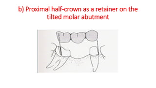 b) Proximal half-crown as a retainer on the
tilted molar abutment
 