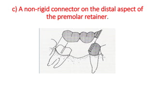 c) A non-rigid connector on the distal aspect of
the premolar retainer.
 