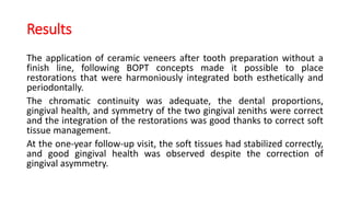 Results
The application of ceramic veneers after tooth preparation without a
finish line, following BOPT concepts made it possible to place
restorations that were harmoniously integrated both esthetically and
periodontally.
The chromatic continuity was adequate, the dental proportions,
gingival health, and symmetry of the two gingival zeniths were correct
and the integration of the restorations was good thanks to correct soft
tissue management.
At the one-year follow-up visit, the soft tissues had stabilized correctly,
and good gingival health was observed despite the correction of
gingival asymmetry.
 