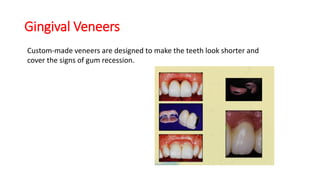 Gingival Veneers
Custom-made veneers are designed to make the teeth look shorter and
cover the signs of gum recession.
 