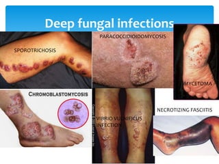 13
Deep fungal infections
SPOROTRICHOSIS
PARACOCCIDIOIDOMYCOSIS
MYCETOMA
VIBRIO VULNIFICUS
INFECTION
NECROTIZING FASCIITIS
 