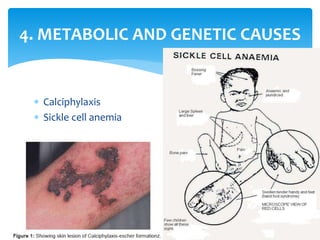  Calciphylaxis
 Sickle cell anemia
16
4. METABOLIC AND GENETIC CAUSES
 