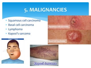  Squamous cell carcinoma
 Basal cell carcinoma
 Lymphoma
 Kaposi’s sarcoma
18
5. MALIGNANCIES
 