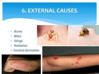  Burns
 Bites
 Stings
 Radiation
 Factitial dermatitis
19
6. EXTERNAL CAUSES
 