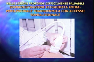 NELLE LESIONI PROFONDE DIFFICILMENTE PALPABILI SOMMINISTRAZIONE ECOGUIDATA INTRA-PERILESIONALE TRANSDERMICA CON ACCESSO SOVRALESIONALE 