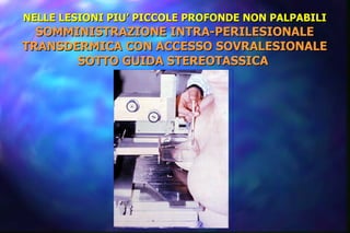 NELLE LESIONI PIU’ PICCOLE PROFONDE NON PALPABILI  SOMMINISTRAZIONE INTRA-PERILESIONALE TRANSDERMICA CON ACCESSO SOVRALESIONALE SOTTO GUIDA STEREOTASSICA  