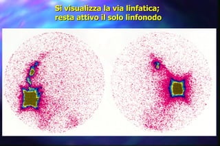 Si visualizza la via linfatica; resta attivo il solo linfonodo 