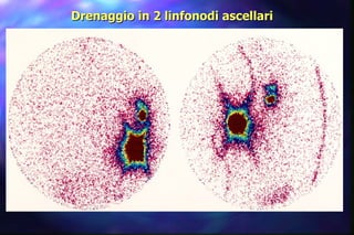 Drenaggio in 2 linfonodi ascellari 