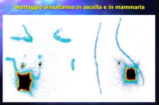 Drenaggio simultaneo in ascella e in mammaria 