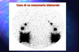 Caso di ca mammario bilaterale 