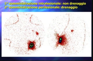 1° somministrazione intralesionale: non drenaggio 2° somministrazione perilesionale: drenaggio 