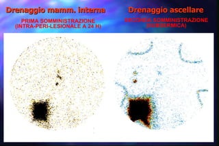 PRIMA SOMMINISTRAZIONE (INTRA-PERI-LESIONALE A 24 H) SECONDA SOMMINISTRAZIONE (SUBDERMICA) Drenaggio mamm. interna Drenaggio ascellare 