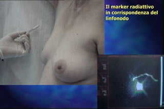 Il marker radiattivo in corrispondenza del linfonodo 