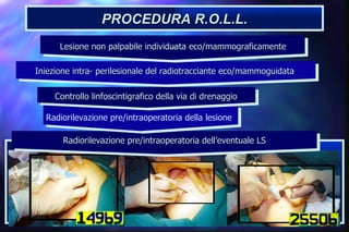 PROCEDURA R.O.L.L. Radiorilevazione pre/intraoperatoria dell’eventuale LS  Radiorilevazione pre/intraoperatoria della lesione Controllo linfoscintigrafico della via di drenaggio  Iniezione intra- perilesionale del radiotracciante eco/mammoguidata  \ Lesione non palpabile individuata eco/mammograficamente  