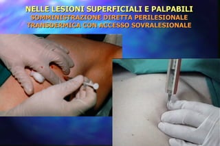 NELLE LESIONI SUPERFICIALI E PALPABILI SOMMINISTRAZIONE DIRETTA PERILESIONALE TRANSDERMICA CON ACCESSO SOVRALESIONALE 
