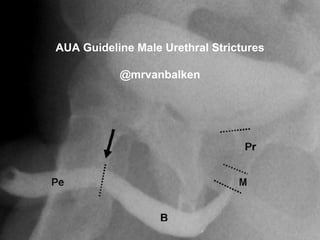 v
AUA Guideline Male Urethral Strictures
@mrvanbalken
 