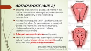 ADENOMYOSIS (AUB-A)
 presence of endometrial glands and stroma in the
uterine myometrium.  ectopic endometrial tissue
le...