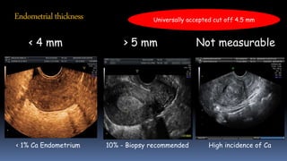 Endometrialthickness
< 4 mm > 5 mm Not measurable
< 1% Ca Endometrium 10% - Biopsy recommended High incidence of Ca
Universally accepted cut off 4.5 mm
 