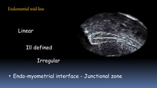 Endometrialmid-line
Linear
Ill defined
Irregular
• Endo-myometrial interface - Junctional zone
 