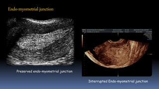 Interrupted Endo-myometrial junction
Preserved endo-myometrial junction
Endo-myometrial junction
 
