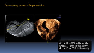 Intracavitarymyoma- Prognostication
Grade ‘0’ -100% in the cavity
Grade ‘1’ - 50% in the cavity
Grade ‘2’ - < 50% in the cavity
 