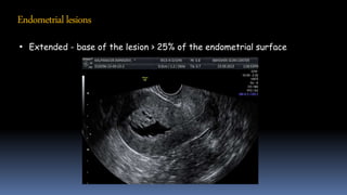 Endometriallesions
• Extended - base of the lesion > 25% of the endometrial surface
 
