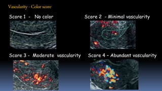 Vascularity- Colorscore
Score 1 - No color Score 2 - Minimal vascularity
Score 3 - Moderate vascularity Score 4 – Abundant vascularity
 