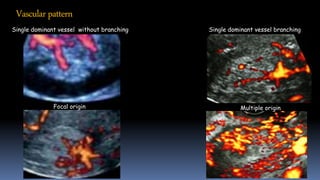 Vascularpattern
Single dominant vessel without branching Single dominant vessel branching
Focal origin Multiple origin
 