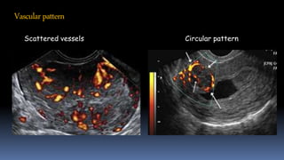 Vascularpattern
Scattered vessels Circular pattern
 