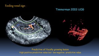 Predictive of focally growing lesion
High positive predictive value but low negative predictive value
Timmerman 2003 UOG
Feeding vessel sign
 