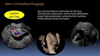 Gel contains lidocaine hydrochloride 20 mg/g,
Chlorhexidine digluconate, methyl hydroxybenzoate,
propyl hydroxybenzoate, sodium lactate, hydroxy-
ethylcellulose and purified water
Lesion
out line
Saline/Gel Installation Sonography
 