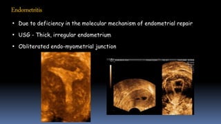 Endometritis
• Due to deficiency in the molecular mechanism of endometrial repair
• USG - Thick, irregular endometrium
• Obliterated endo-myometrial junction
 