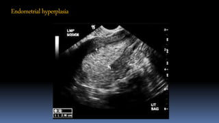 Endometrialhyperplasia
 