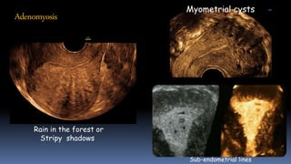 Adenomyosis
Rain in the forest or
Stripy shadows
Myometrial cysts
Sub-endometrial lines
 