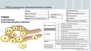 19
FIGO Leiomyoma subclassification system
P A L M C O E I N
 