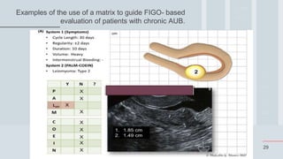 29
Examples of the use of a matrix to guide FIGO- based
evaluation of patients with chronic AUB.
 