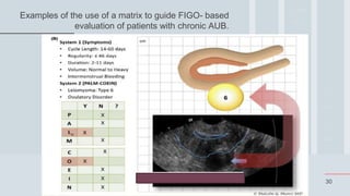 30
Examples of the use of a matrix to guide FIGO- based
evaluation of patients with chronic AUB.
 