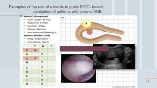 31
Examples of the use of a matrix to guide FIGO- based
evaluation of patients with chronic AUB.
 